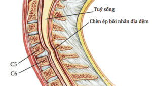 chèn ép rễ thần kinh